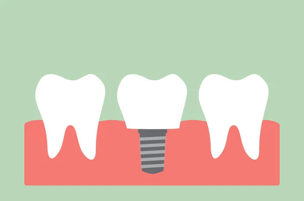 Implant diş taç ile — Stok Vektör