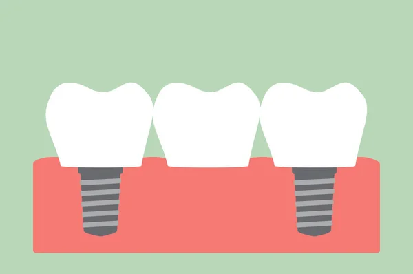 Puente dental - implante dental — Archivo Imágenes Vectoriales