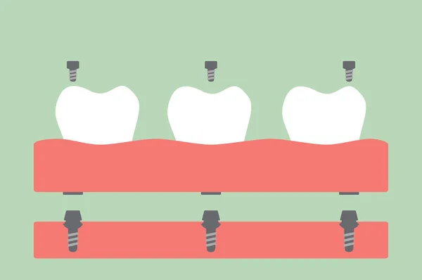 Prothèses dentaires, prothèse dentaire de remplissage sur gomme — Image vectorielle