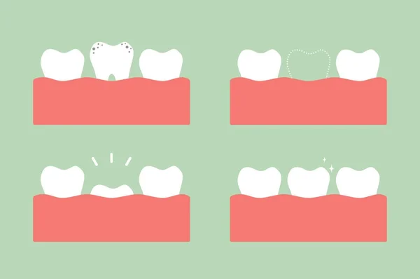 Step of caries to first teeth — Stock Vector