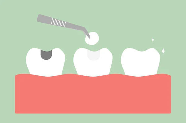 Zahnamalgamfüllung mit Zahnwerkzeugen — Stockvektor