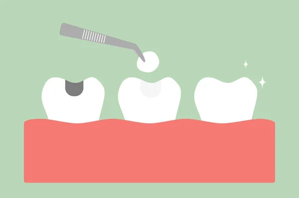 Relleno de amalgama dental con herramientas dentales — Vector de stock