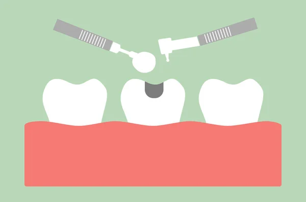 Enchimento de amálgama dentária com ferramentas dentárias — Vetor de Stock