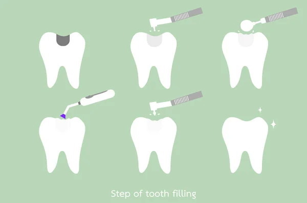 Krok kaz Zubní amalgám plnění s dentální nástroje — Stockový vektor