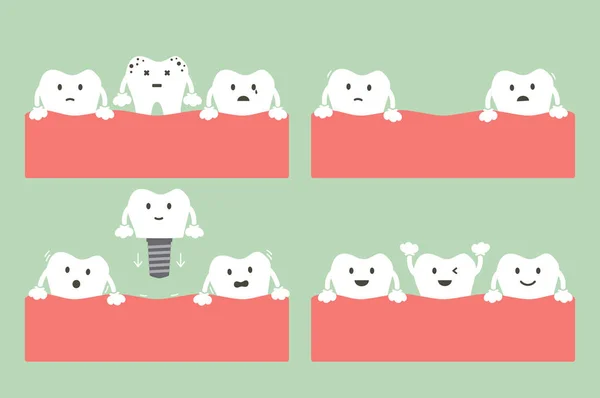 Paso de caries a implante dental con corona — Archivo Imágenes Vectoriales