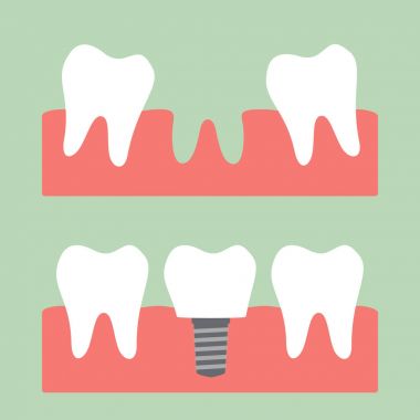 implant diş taç ile doldurma