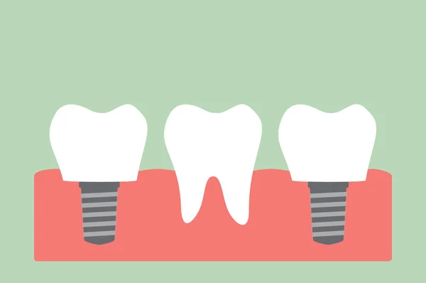 Implants dentaires avec couronne — Image vectorielle