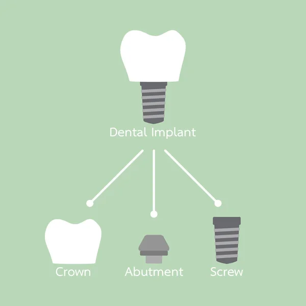 Структура зубного імплантату з усіма частинами розібраними, короною, абатментом, гвинтом — стоковий вектор