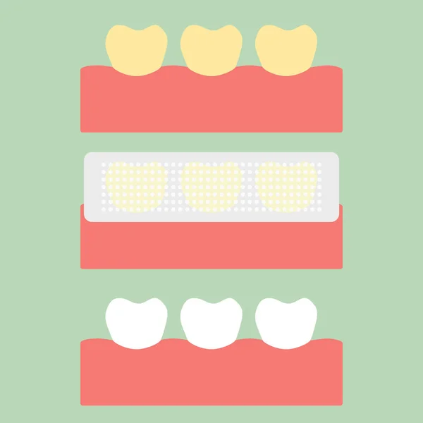 Этап использования полоса отбеливания зубов, желтый - белый зуб — стоковый вектор