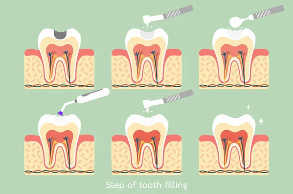 Passo de cárie para recheio de amálgama dentária com ferramentas dentárias —  Vetores de Stock