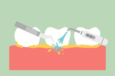 ölçekleme, dental plak kaldırma temizleme diş