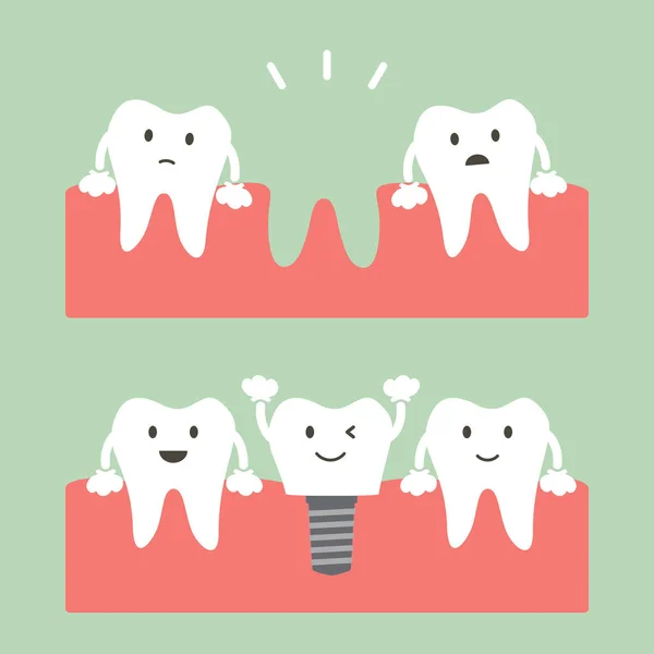 Enchimento de implante dentário com coroa, antes e depois — Vetor de Stock