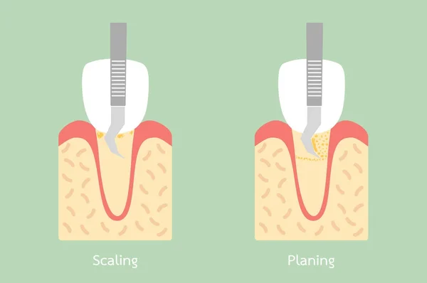 Skalierung der Zähne - Entfernung von Belägen, anatomische Struktur einschließlich Knochen und Zahnfleisch — Stockvektor