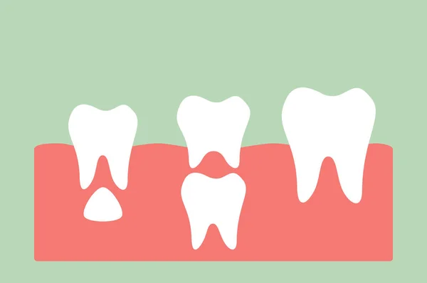 Dente permanente localizado abaixo do dente primário — Vetor de Stock