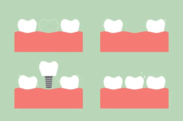 Paso de caries a implante dental con corona, antes y después — Archivo Imágenes Vectoriales