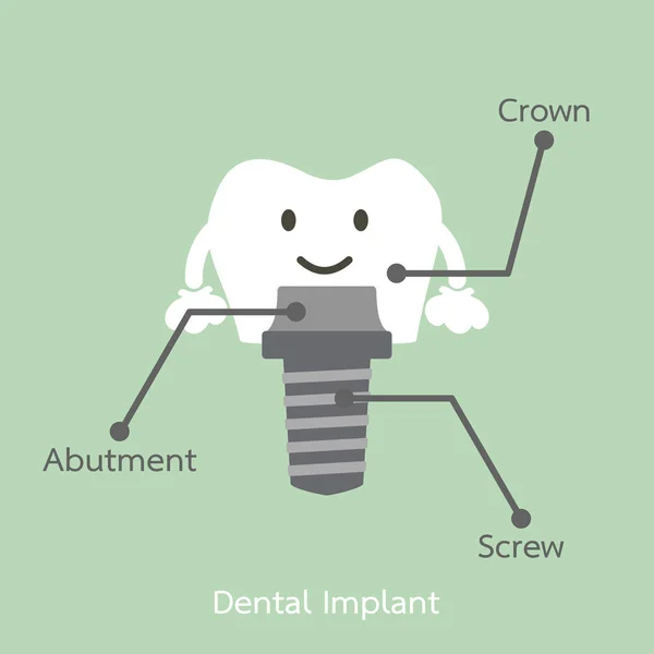 Estructura del implante dental con todas las partes desmontadas, corona, estribo, tornillo — Archivo Imágenes Vectoriales