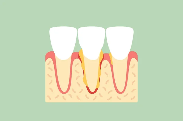 Periodontal hastalık veya kesici diş dişeti iltihabı — Stok Vektör