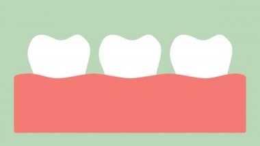 dişeti iltihabı veya dişeti hastalığı, diş eti iltihabı önce periodontal hastalık - diş çizgi film vektör düz stil render 2d görüntüleri animasyon, 4k ve Uhd ultra yüksek çözünürlüklü video formatı 3840 x 2160