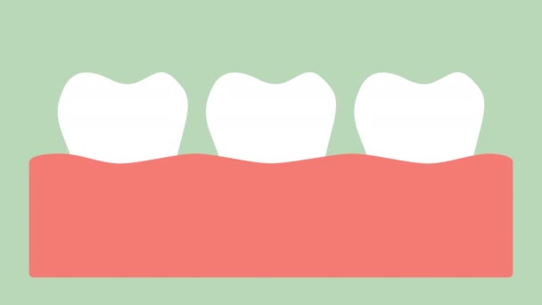 Gengivite Doença Gengival Inflamação Gengival Antes Doença Periodontal Desenho Animado — Vídeo de Stock