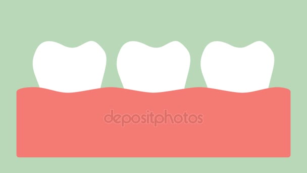 Plaque Gum Gingivitis Gum Disease Dental Cartoon Vector Flat Style — Stock Video