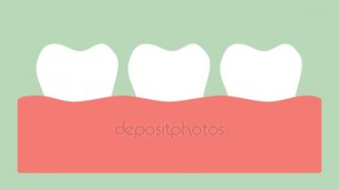kanaması dişeti iltihabı veya dişeti hastalığı, diş eti iltihabı önce periodontal hastalık - diş çizgi film vektör düz stil render 2d görüntüleri animasyon, 4k ve Uhd ultra yüksek çözünürlüklü video formatı 3840 x 2160