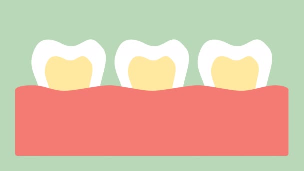 Stages Tooth Decay Dental Caries Teeth Cartoon Vector Flat Style — Stock Video