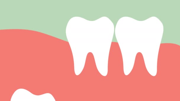 Inflamación Muela Del Juicio Impactación Angular Mesial Vector Dibujos Animados — Vídeos de Stock