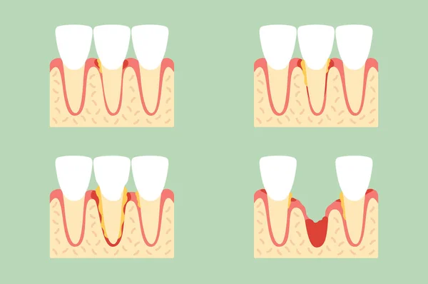 Step of periodontal disease or gingivitis of incisor tooth — Stock Vector