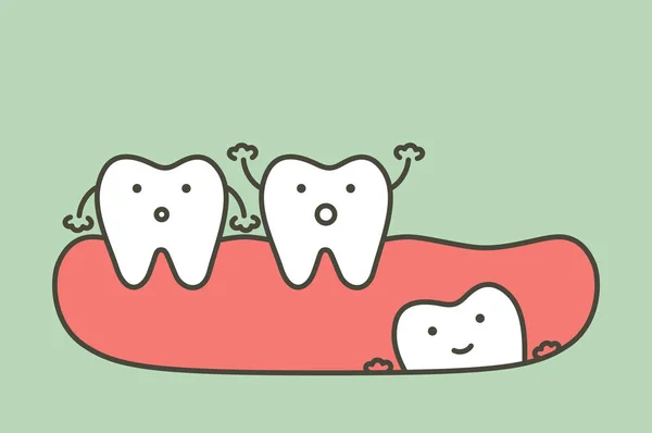 Weisheitszahn (eckiger oder mesialer Aufprall) auf andere Zähne — Stockvektor