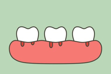 kanama periodontitis veya dişeti hastalığı (kan akımı geliyor dişeti ve diş), diş sorunu