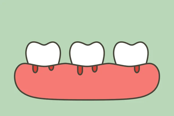 Parodontite ou maladie des gencives avec saignement (flux sanguin provenant de la gencive et de la dent), problème dentaire — Image vectorielle