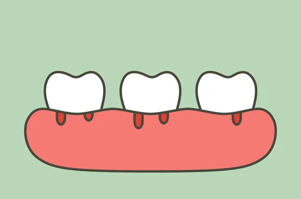 Periodontite ou doença gengival com sangramento (fluxo sanguíneo proveniente de gengiva e dente), problema dentário — Vetor de Stock