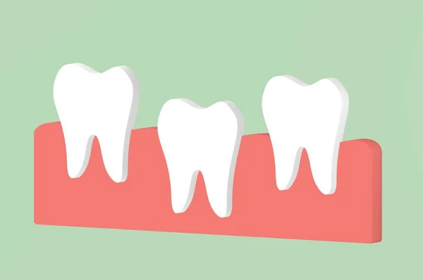 Primeiro dente, dente crescendo a partir de chiclete e entre outros dentes — Fotografia de Stock