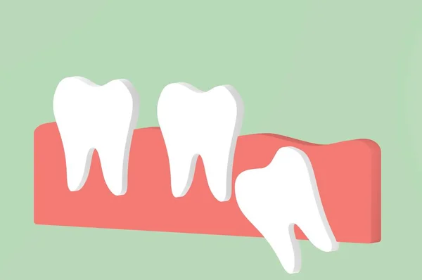 wisdom tooth ( angular or mesial impaction ) affect to other teeth
