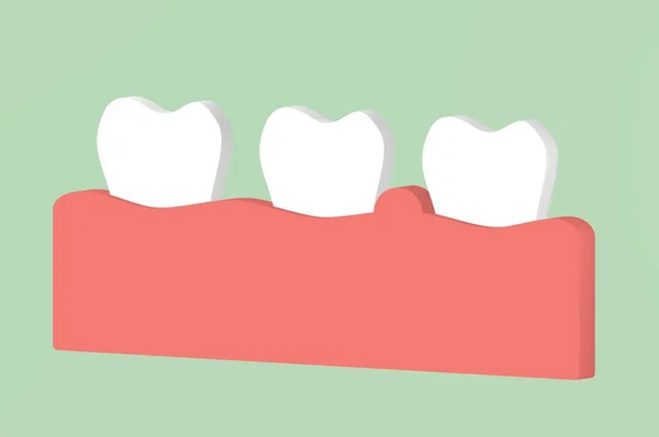 Gengivite ou doença periodontal, inflamação do tecido gengival ao redor dos dentes — Fotografia de Stock