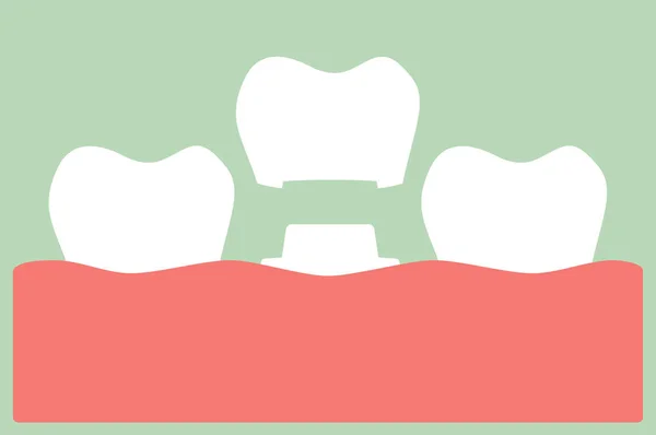 Corona dental, proceso de instalación y cambio de dientes — Vector de stock