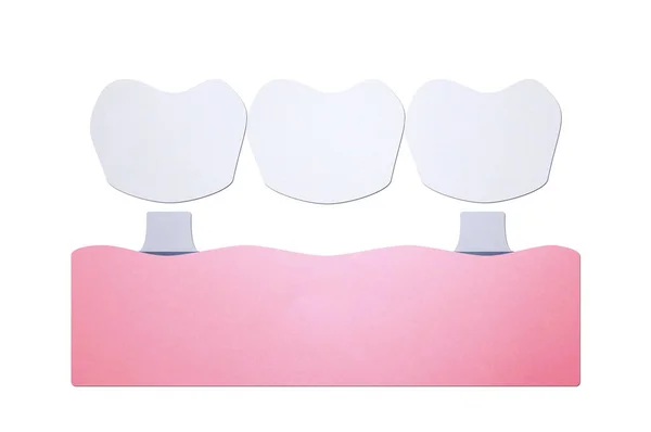 Зубной имплантат с мостом, процесс установки и замены нового корня для зубов — стоковое фото