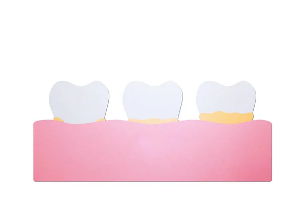 Step of plaque or tartar, cause of tooth periodontal disease — Stock Photo, Image