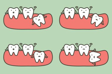 type of wisdom tooth affect to other teeth clipart