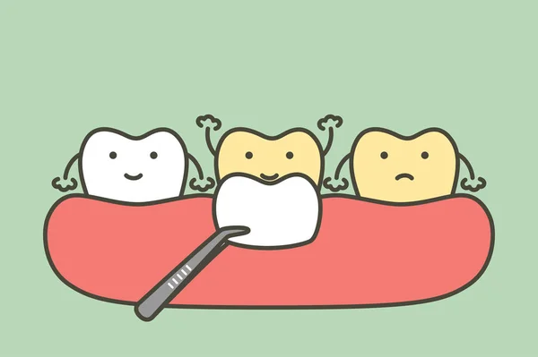 歯のベンダーのインストール手順白歯 — ストックベクタ