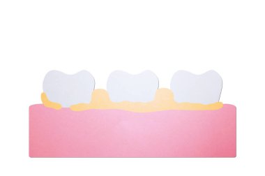 plak veya tartar, diş periodontal hastalık nedeni