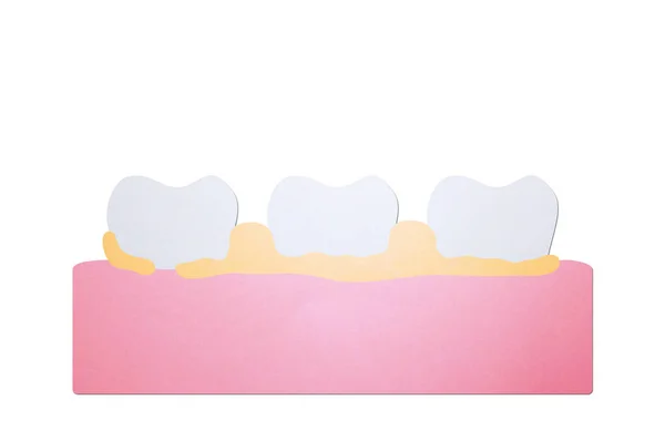 Placa ou tártaro, causa da doença periodontal do dente — Fotografia de Stock