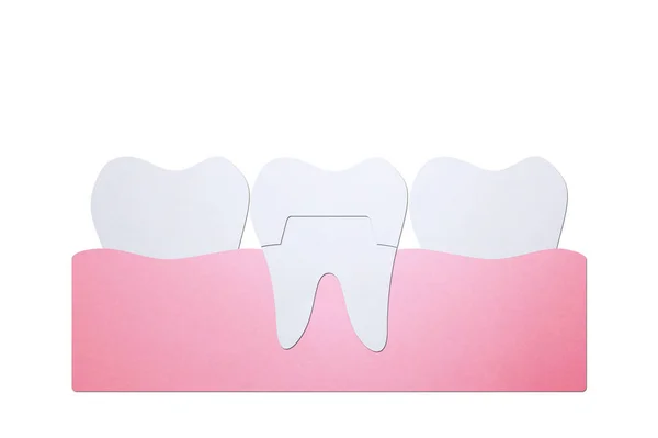 Dental crown, installation process and change of teeth — Stock Photo, Image