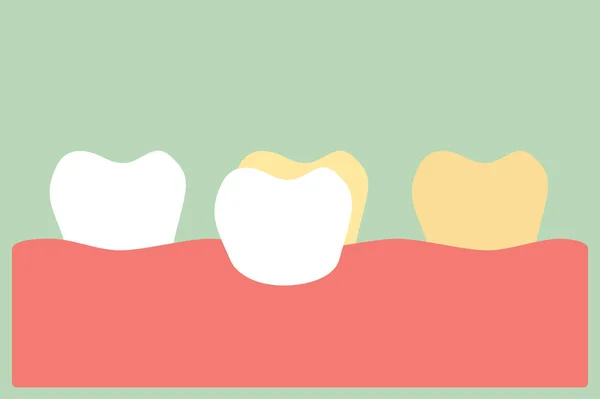 Folheados dentários procedimento de instalação para clareamento dental —  Vetores de Stock