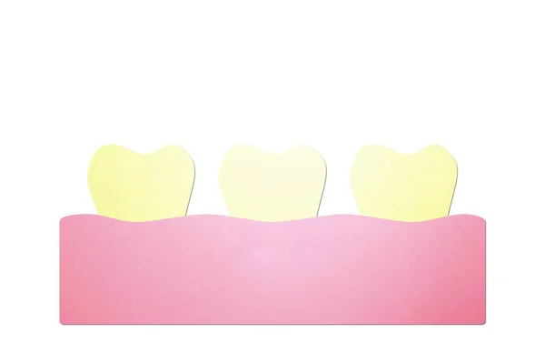 Yellow teeth, dental plaque or tartar — Stock Photo, Image