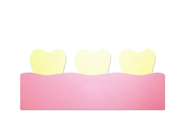 黄色い歯歯垢やタール — ストック写真
