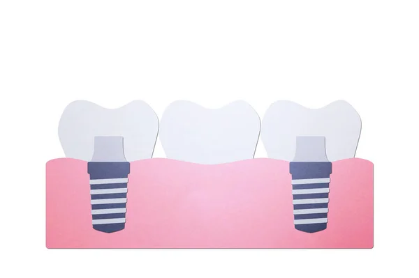 Tooth implant with bridge, installation process and change new root for teeth — Stock Photo, Image