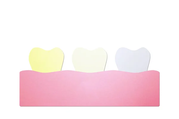 Žluté až bílé zuby, bělení zubů před a po — Stock fotografie