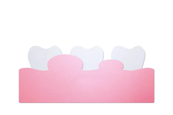 Periodontitida nebo onemocnění dásní s otoky (otok dásní a zubů, protože zánět), zubní potíže — Stock fotografie