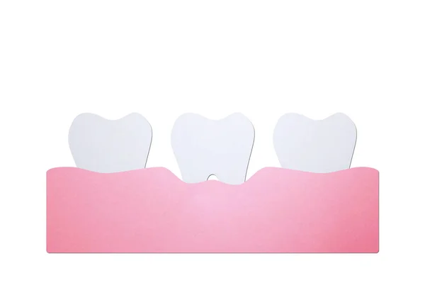 Periodontitis or gum disease, dental problem — Stock Photo, Image